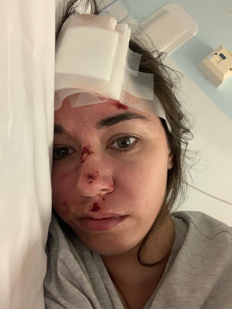 Bronagh lying in bed, showing facial injuries sustained during a seizure.