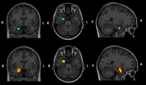 MRI scan