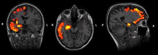 MRI scan