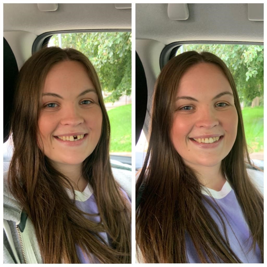 Abbie is photographed without her tooth and with her new tooth. she is smiling and has long brown hair and is wearing a purple t shirt