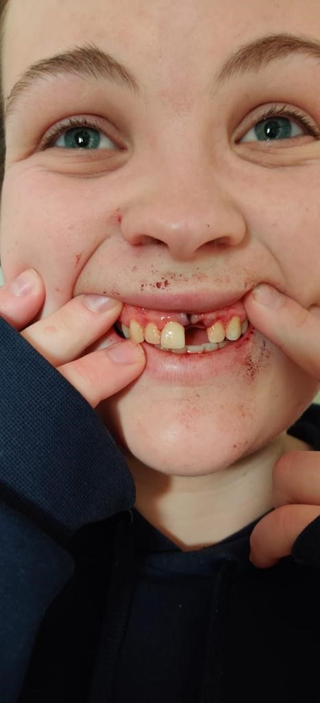 Abbie shows the gap in her front teeth just affter losing a tooth during a seizure