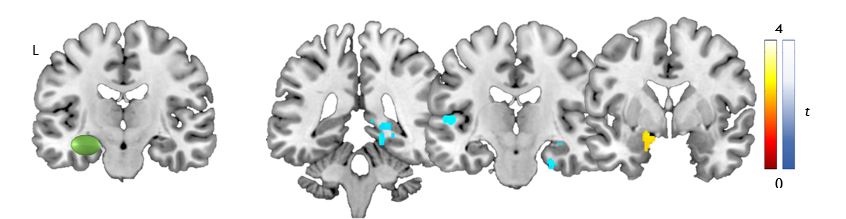 We have created memory fMRI tests to localise memory functions in people with epilepsy and to predict memory effects of epilepsy surgery, and how epilepsy affects memory (Fig 11).