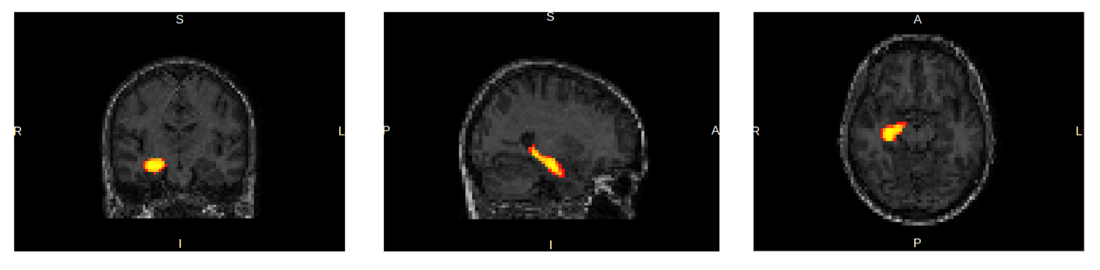 Automated detection of hippocampal sclerosis using contemporary machine learning approaches (Fig 5).