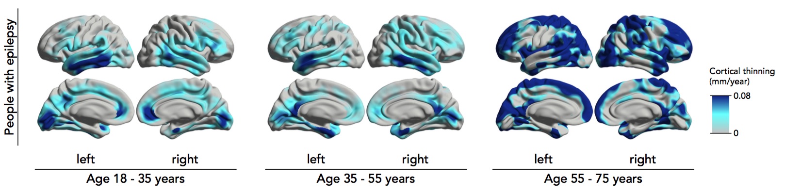 We have used serial MRI to demonstrate the accelerated loss of the gray matter of the brain over years in individuals with  epilepsy, indicating the progressive effects of epilepsy on the brain (Fig 7). This will be invaluable in trials of therapies to prevent this damage. 