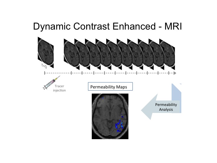 Brain inflammation occurs in epilepsy and depression. We will use novel MRI to demonstrate  this brain inflammation that may give rise to seizures and depression (Fig 8) so that we may identify effective therapies.