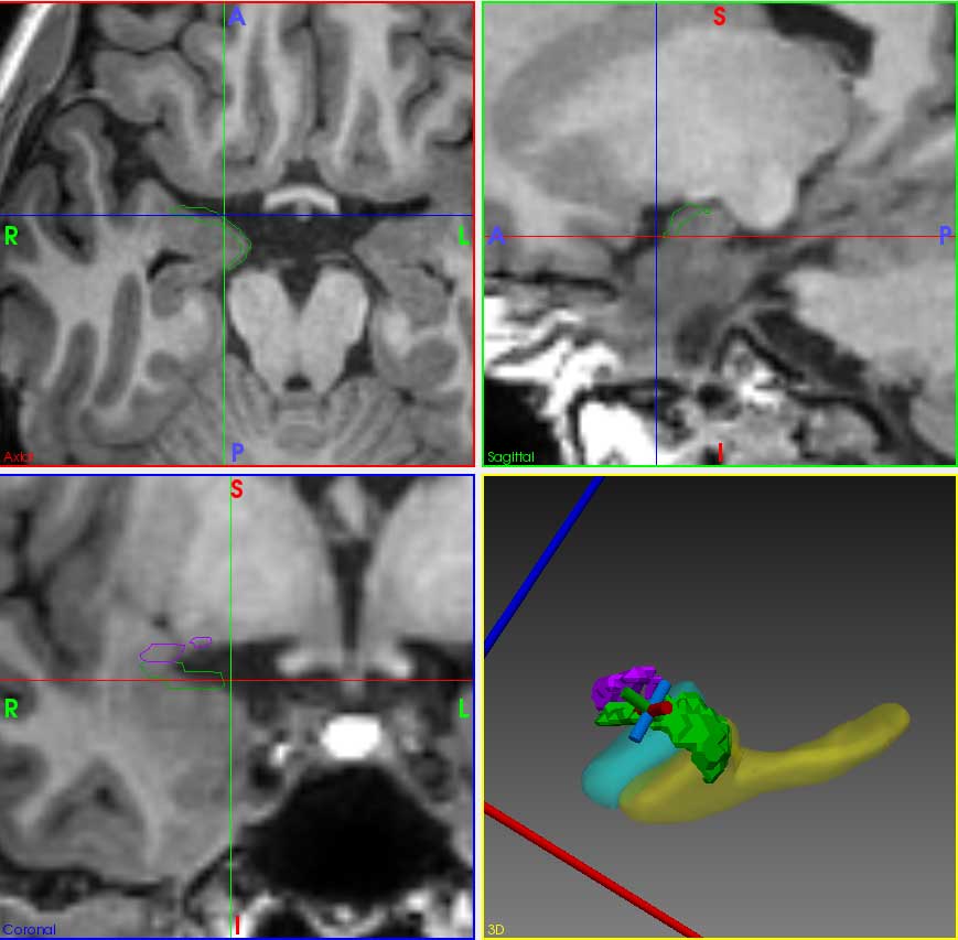 The part to be removed is shown in green in the orthogonal 2D  and 3D images. The part indicated in purple is in the frontal lobe and needs to be left intact.  These data are uploaded to the neurosurgical navigation system to guide the surgery (Fig 1). 