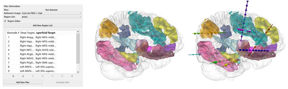 The green area is to be resected and the pale blue, that is needed for motor control, is to be spared (Fig 3).