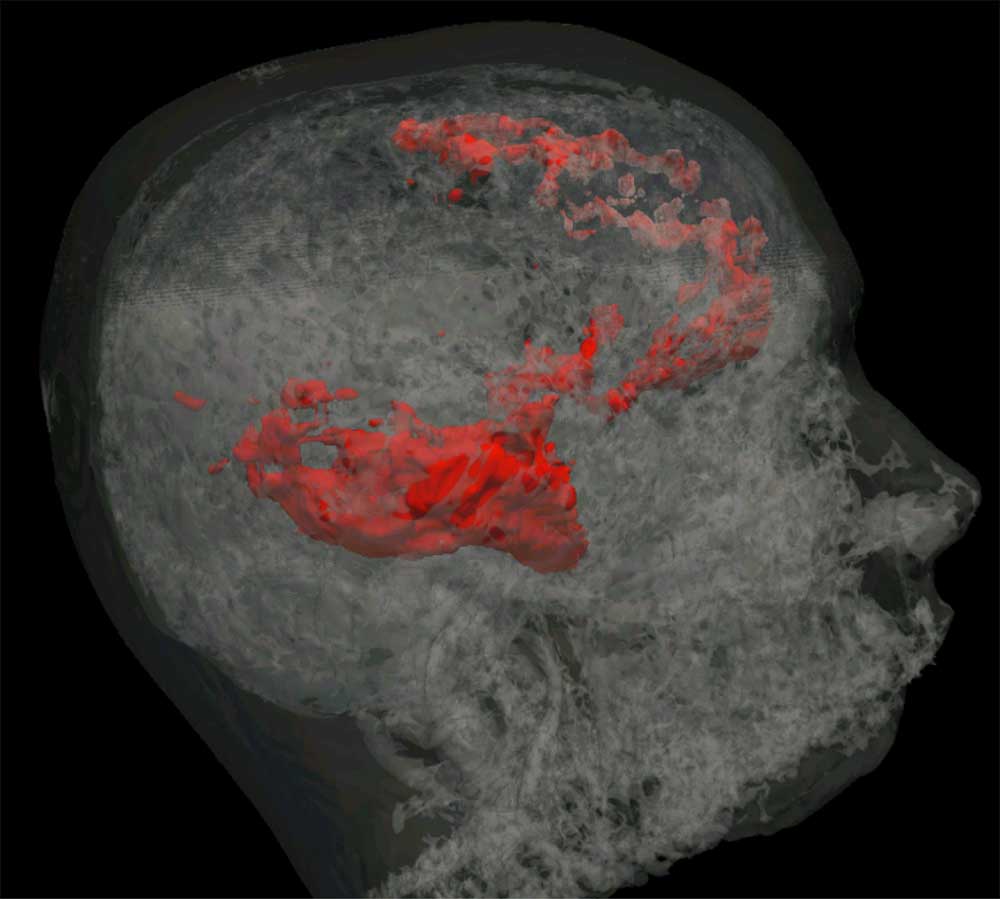 In the case shown, we identified abnormalities in the right temporal and frontal lobes. A right frontal lobe resection was carried out after stereo EEG, and seizure-freedom post-surgery was achieved (Fig 6).