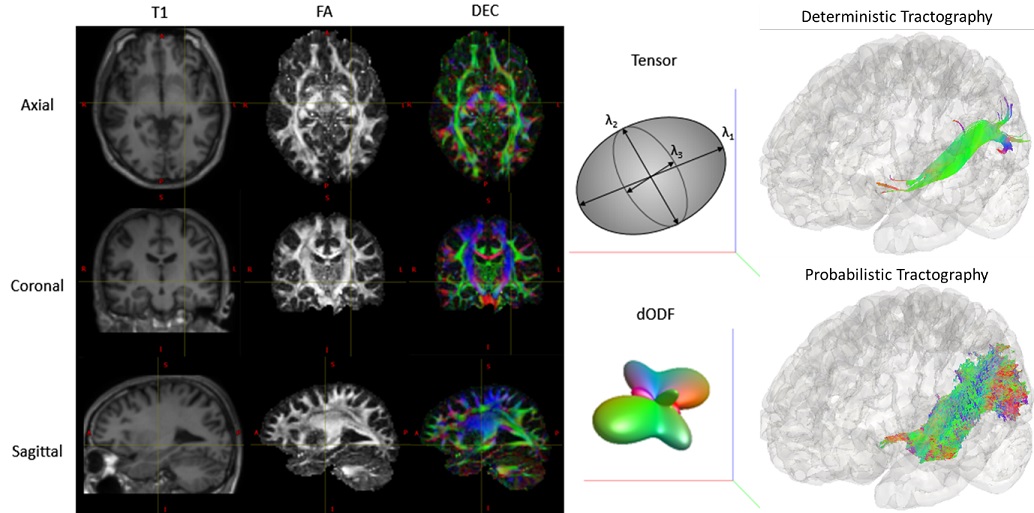 We need to precisely visualize the parts of the brain needed for vision, so that they are not damaged in epilepsy surgery, we have developed refined methods to do this (Fig 4).