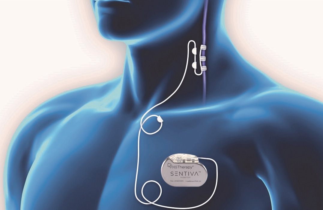 Vagus Nerve Stimulation Device