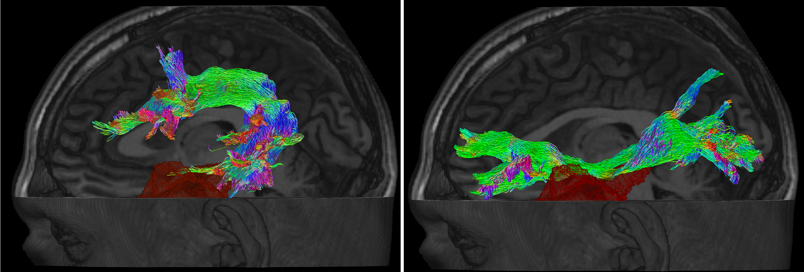 Two fibre bundles involved in language at risk of damage during temporal lobe epilepsy surgery: arcuate fasciculus (left), inferior fronto-occipital fasciculus (right) are damaged in this example, with the resection indicated in red.
