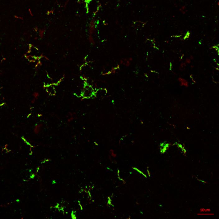 Inflammation in the epileptic brain. Microglial cells (fluourescent green patch in the centre of the slide) are seen in the brain tissue of people with epilepsy.