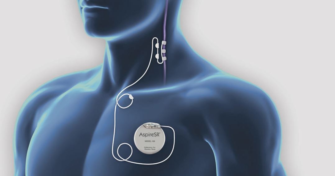 Vagus Nerve Stimulation (VNS) | Epilepsy Society