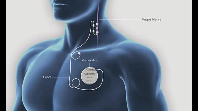 Vagus Nerve Stimulation (VNS) Therapy™ | Epilepsy Society