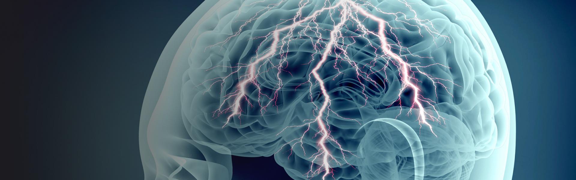 A metaphor for epilepsy