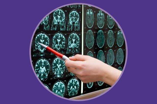 What is epilepsy banner